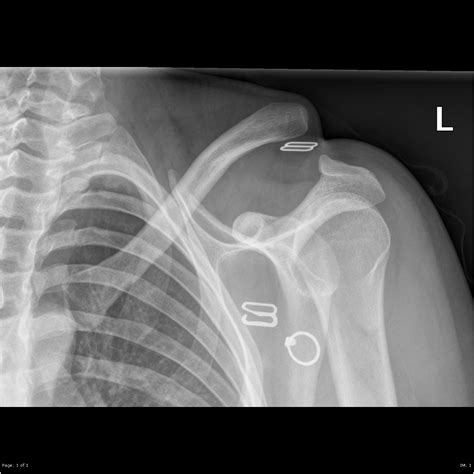 Acromioclavicular Joint Dislocation Image