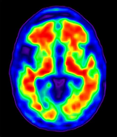 Brain Activity Study Offers Potential Insight Into Alzheimers Disease