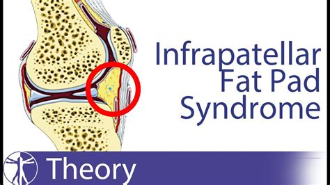 Hoffa Fat Pad Impingement Syndrome Captions Hd