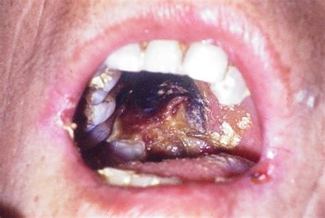 Mucormicosis es el término general que se le da a cualquier infección por hongos causada por varios géneros de la clase zygomycetes. EL RINCON DE LA MENTE: VISITA TU DENTISTA