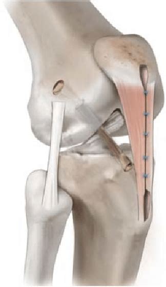 Anterior Cruciate Ligament Reconstruction With Bone Patellar