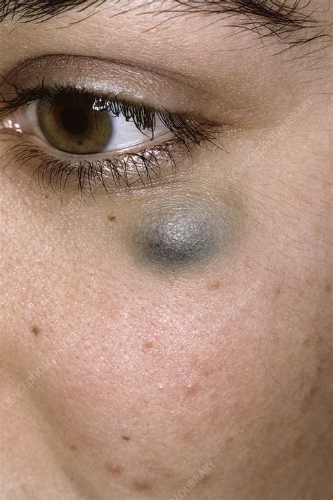 Blue Nevus Stock Image C0516921 Science Photo Library