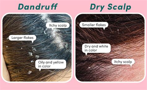 7 Dandruff Myths To Stop Believing Asap Coco And Eve