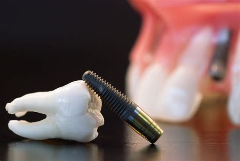 Limplant Dentaire Une Solution Avantageuse Bücco Orthodontie Par