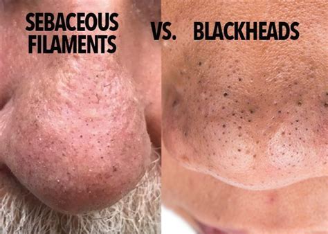 Blackheads Can Be A Satisfying Bunch A Little Bit Of Gently Applied