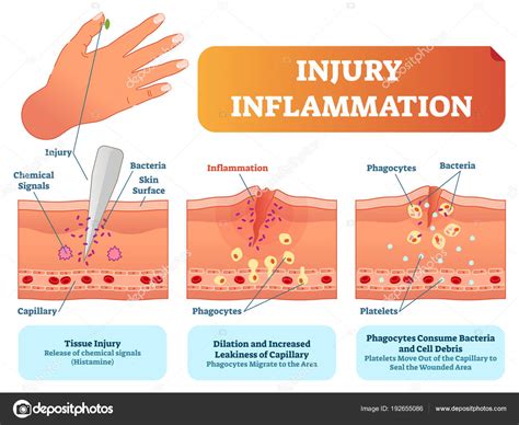 Injury Inflammation Biological Human Body Response Vector Illustration