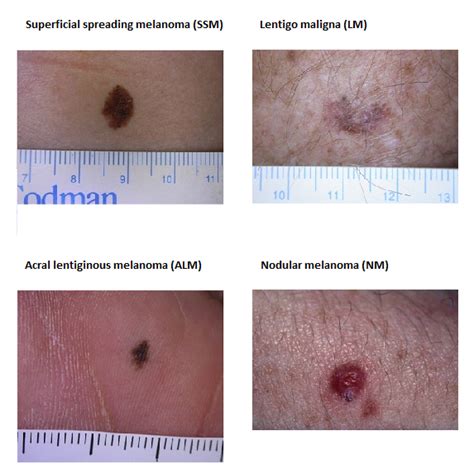 Skin Cancer Types National Cancer Prevention Policy Skin Cancer