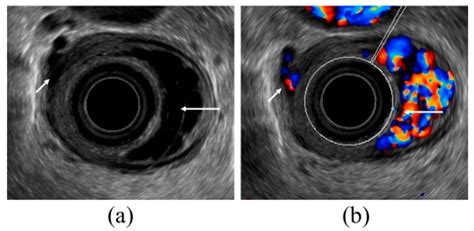 Diagnostics Free Full Text The Role Of Endoscopic Ultrasound For