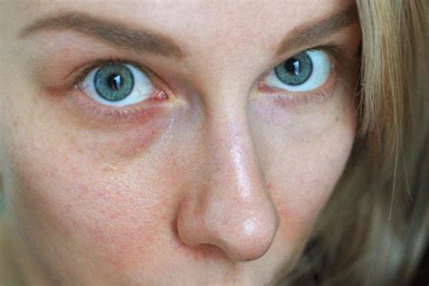 How To Get Rid Of Broken Capillaries Of The Face Blood Vessels On