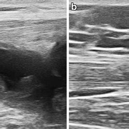 Ultrasound Longitudinal To The Suprapatellar Recess In An Year Old My XXX Hot Girl