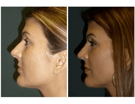 Before And After Gallery Houston Tx Houston Sinus Surgery
