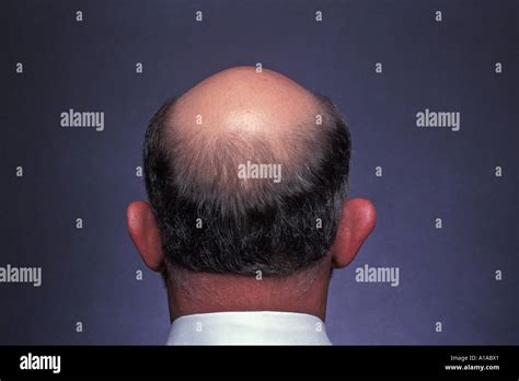 Back View Of Man With Bald Spot On Head Wearing White Shirt Stock Photo