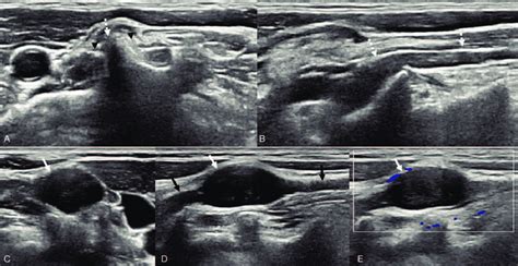 A And B Normal Left Cervicalbrachial Plexus A Axial Ultrasonography