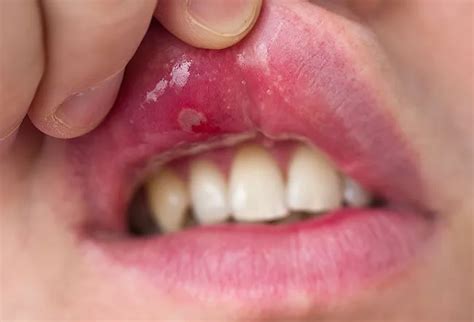What Is Stomatitis Caused By