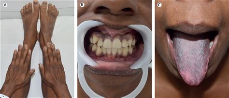 Crisis What Crisis Abdominal Pain And Darkening Skin In Addisons