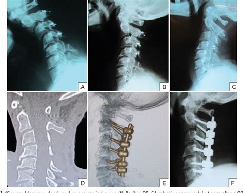 Figure 1 From Management Of Cervical Spine Deformity After Intradural
