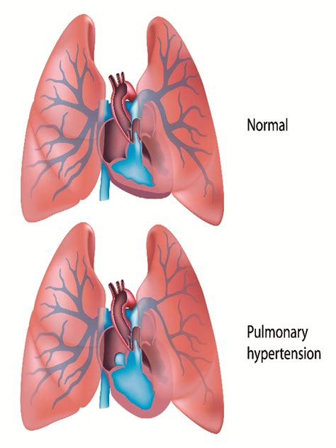 Pulmonary Arterial Hypertension Diagnosis Mims Malaysia