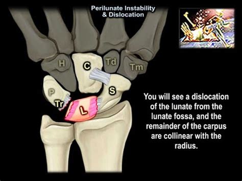 Perilunate Instability Dislocation Everything You Need To Know Dr Nabil Ebraheim YouTube