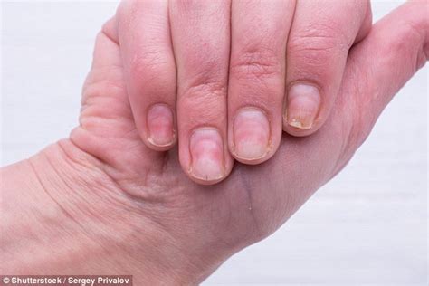 Nail Expert Shares The Best Way To Repair Damaged Nails At Home Daily