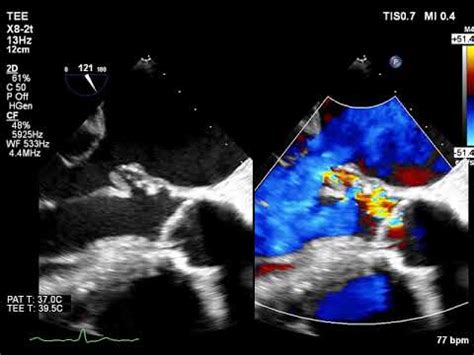 Perforated Mitral Valve Aneurysm Due To Jet Lesion Caused By Infective