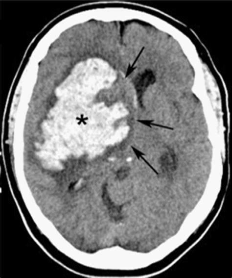 Hemorragia Intracerebral Concise Medical Knowledge The Best Porn