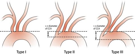 Aortic Arch Types Based On The Relationship Of The Origins Of The