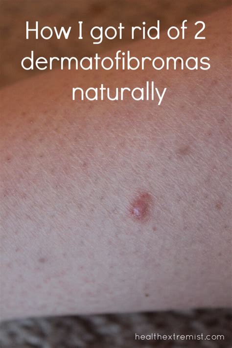 How To Get Rid Of A Dermatofibroma Naturally 2022