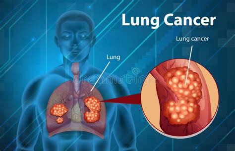 Informative Illustration Of Lung Cancer Stock Vector Illustration Of