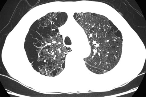 Emphysema Threshold On Ct Imaging May Have Predictive Value For Copd