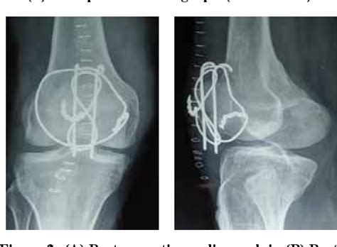 Figure 2 From Study Between Fracture Fixation Of Patella With Cerclage