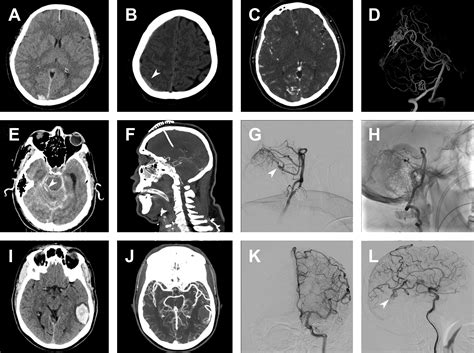 Brain Arteriovenous Malformations Radiology Key