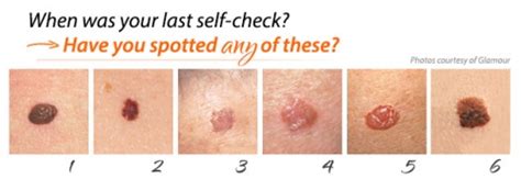 What Skin Cancer Looks Like Inlifehealthcare