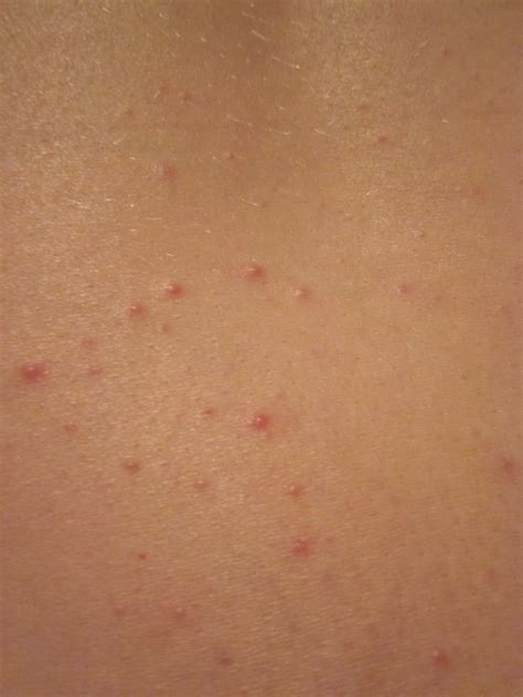 Pimply Rash On Chest Pictures Photos