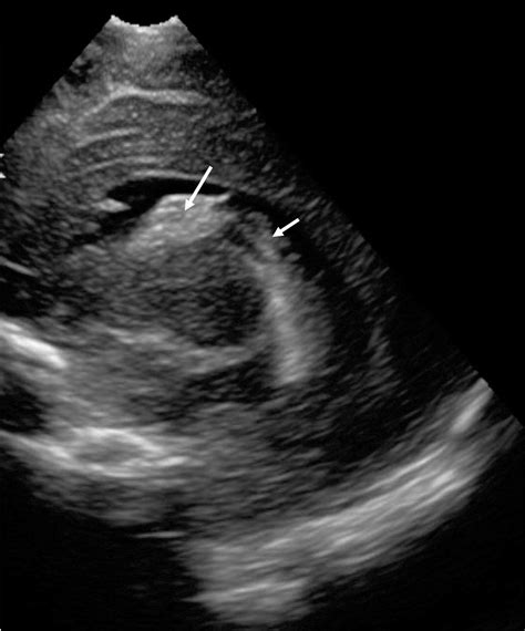 Cranial Ultrasound Findings In Well Newborn Ugandan Infants Adc Fetal
