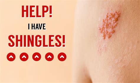 Help I Have Shingles Us Dermatology Partners