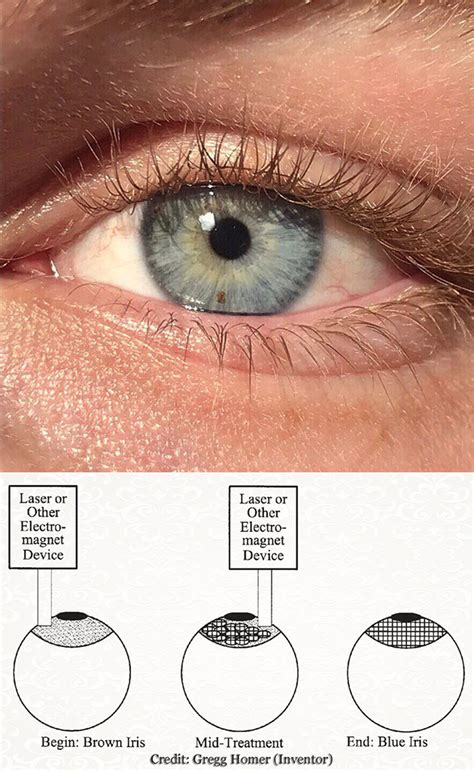 Procedure That Turns Brown Eyes Blue And 15 More Fascinating Images
