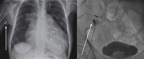 Frontiers Complications Following Percutaneous Mitral Valve Repair
