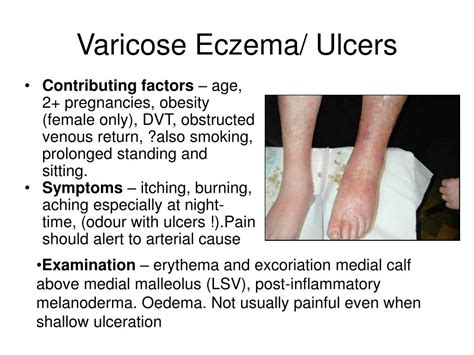 Ppt Varicose Eczema Ulcers Powerpoint Presentation Id147725