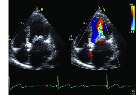 Transthoracic Echocardiogram Showing Features Of Rheumatic Severe