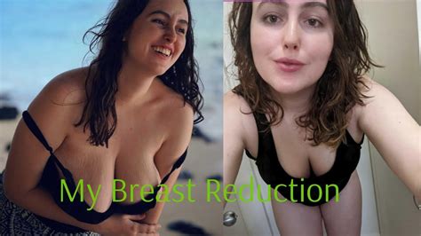 My Breast Reduction Story Youtube