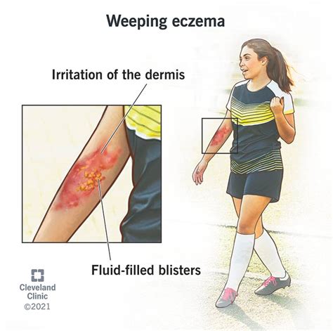 Weeping Eczema Symptoms Causes Treatment And Care