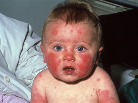 Visual Guide To Childrens Rashes And Skin Conditions Babycenter