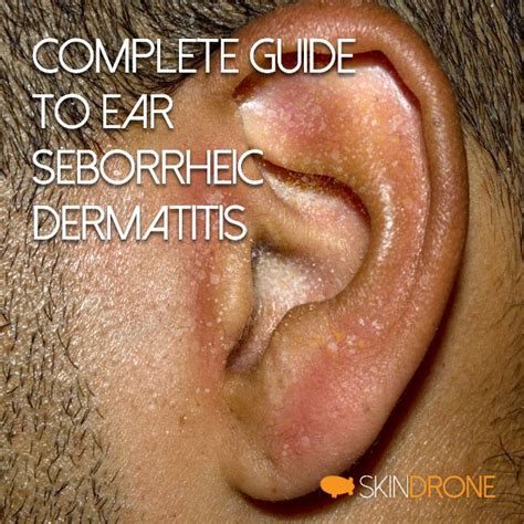 Seborrheic Dermatitis Ear Treatment Hot Sex Picture