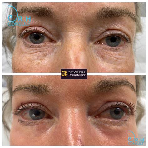 Laser Eyelid Tightening Surgery And Treatment Dr H Consult