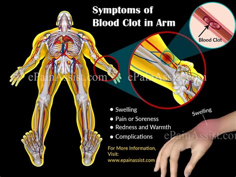 Blood Clot In Armsymptomstreatmenthome Remediesexercises