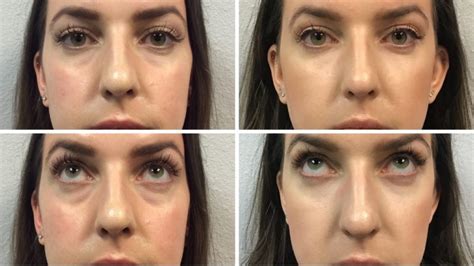 All About Under Eye Filler Restylane Before And After Photos Cost