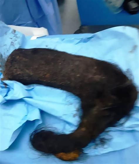 docs remove huge 4 lb hairball from womans stomach viraltab