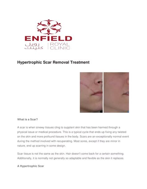 Ppt Hypertrophic Scar Removal Treatment Powerpoint Presentation Free