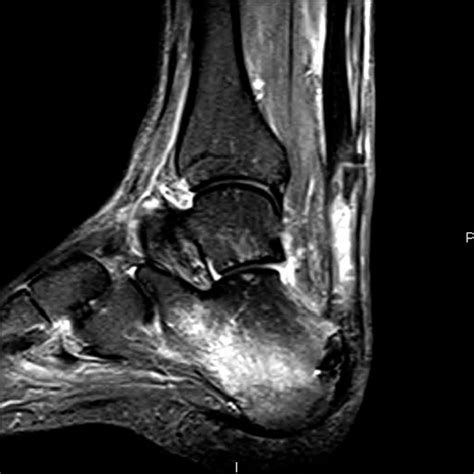 An Ankle Mri Demonstrates A Sagittal Stir Image Of The Achilles Tendon