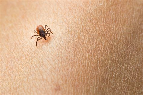 These Horrifying Pictures Show The Exact Tick Bite Symptoms To Look For Wbal Newsradio 1090fm